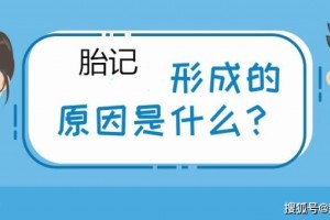 郑州专业的胎记医院医师回答去除胎记的三个误区