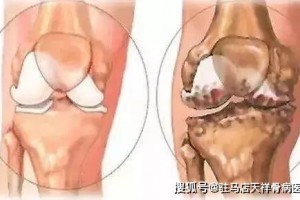 不是一切骨刺都要治一定要科学看待