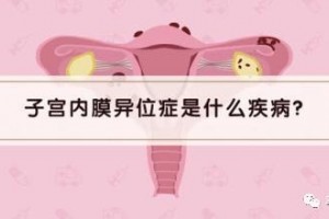 【科普小讲堂】子宫内膜处处乱跑——子宫内膜异位症