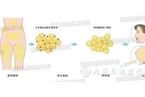 自体脂肪填充仍是玻尿酸填充?怎么正确的挑选?