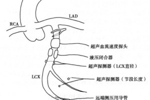 血管机械阻塞导致的心肌梗死模型